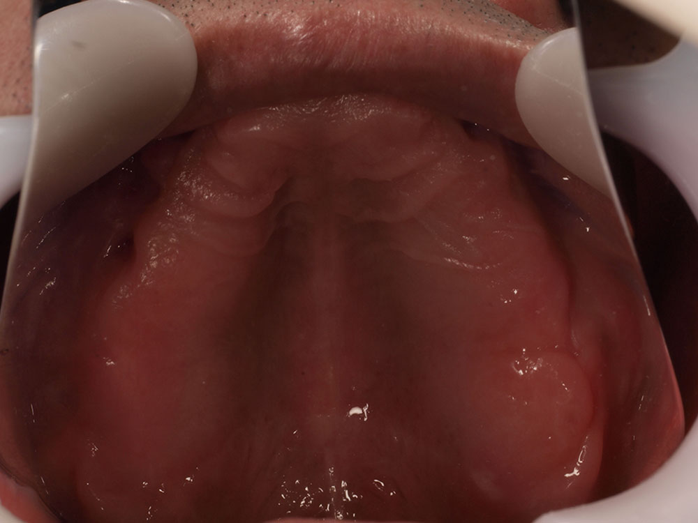 上顎6本（オールオン６） 下顎3本