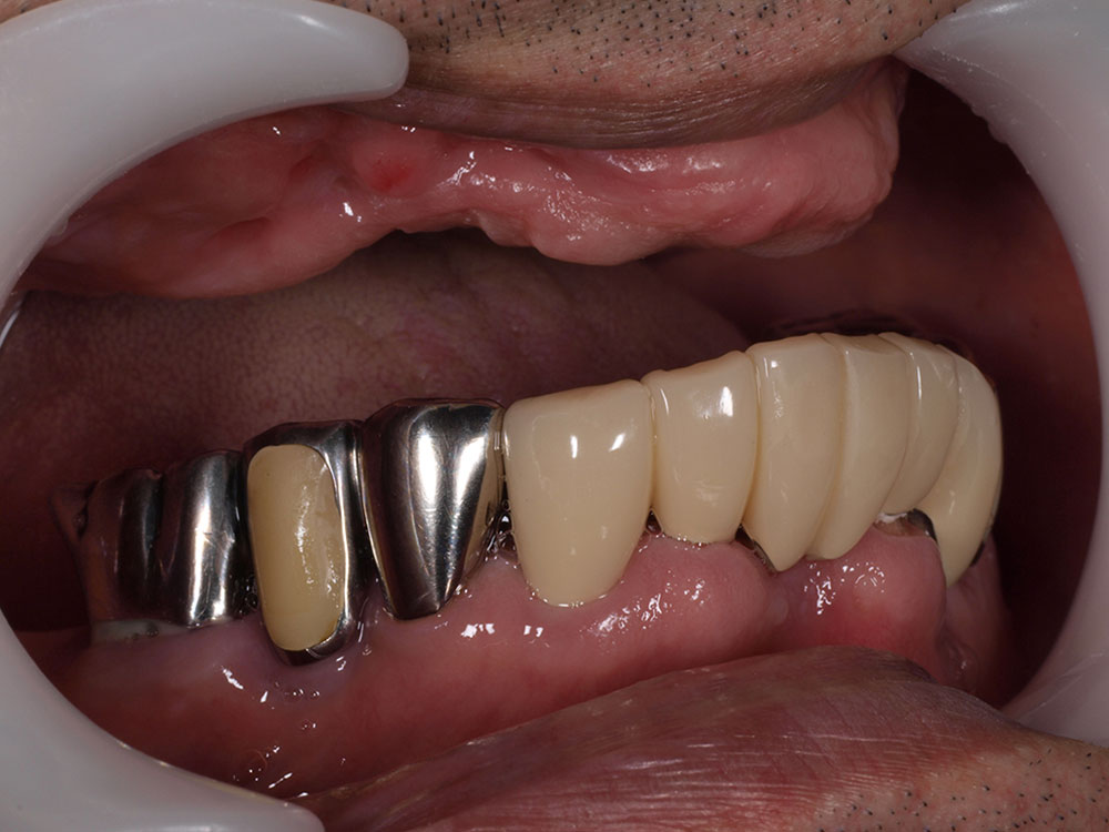 上顎6本（オールオン６） 下顎3本