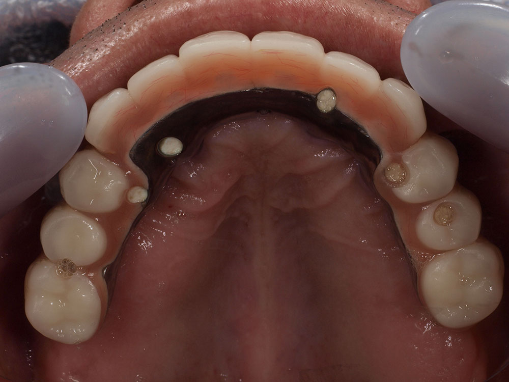 上顎6本（オールオン６） 下顎3本