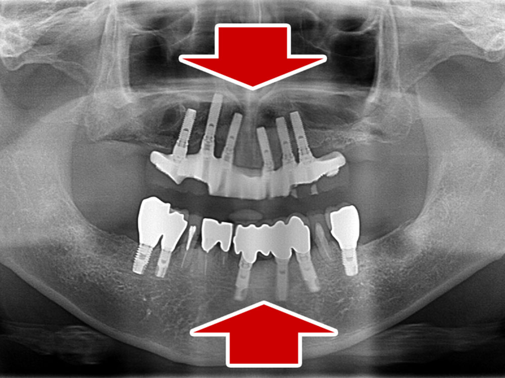 上顎6本（オールオン６） 下顎3本