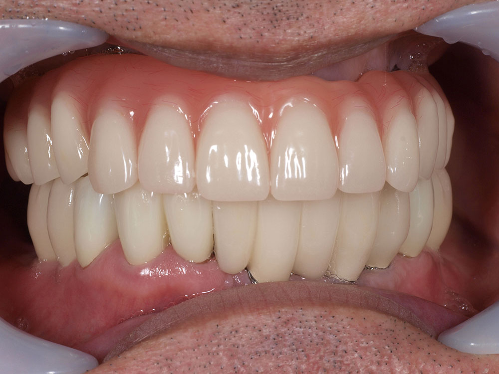 上顎6本（オールオン６） 下顎3本