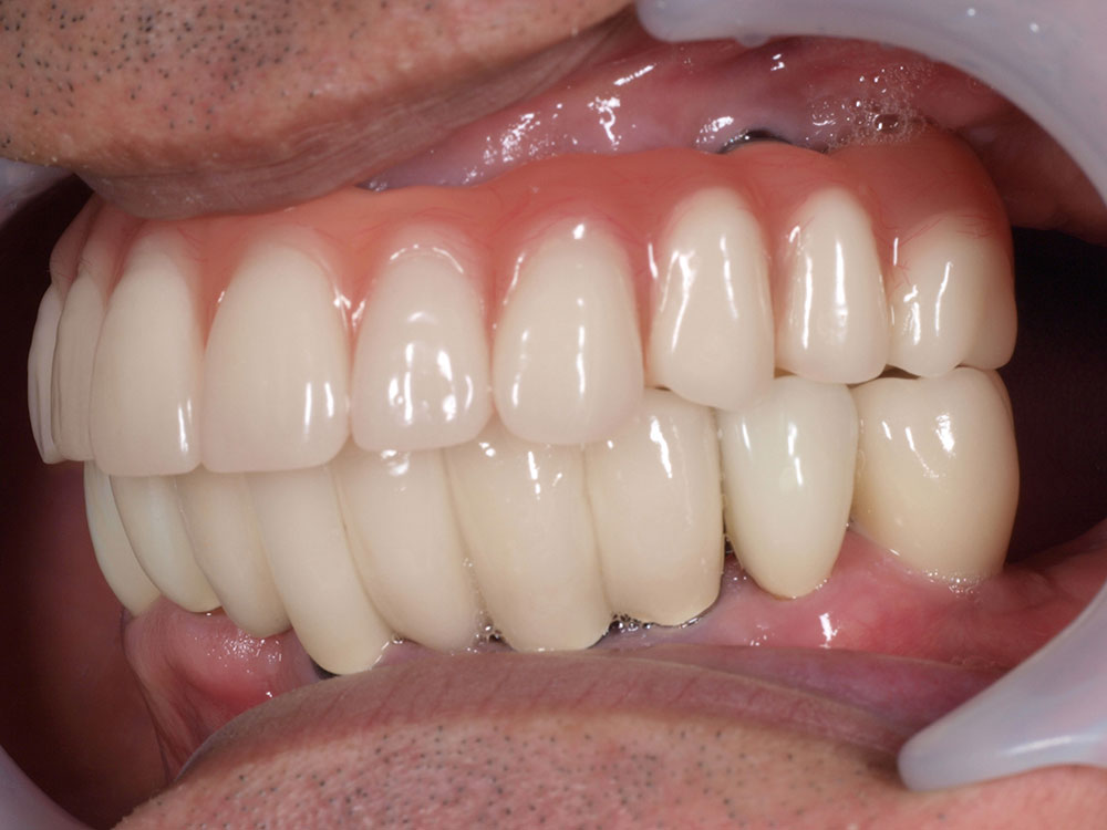 上顎6本（オールオン６） 下顎3本