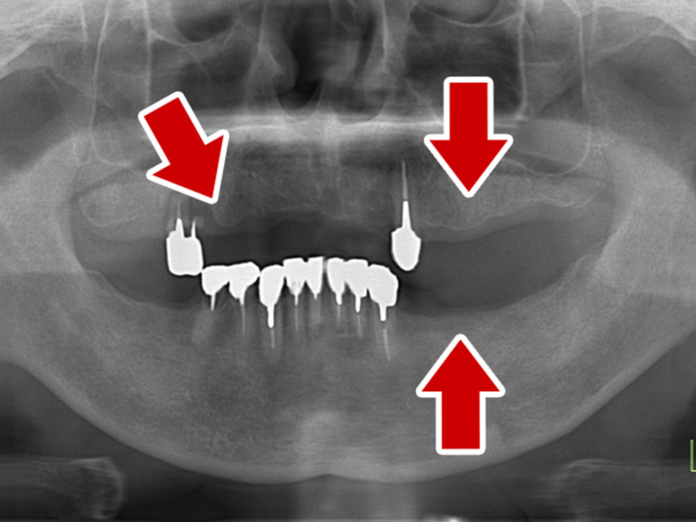 上顎4本で12歯（オールオン４）、下顎4本5歯