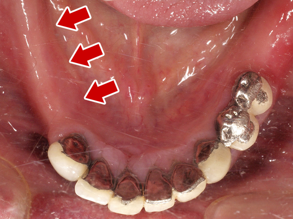 上顎4本で12歯（オールオン４）、下顎4本5歯