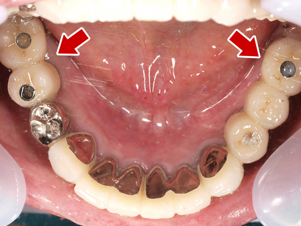 上顎4本で12歯（オールオン４）、下顎4本5歯