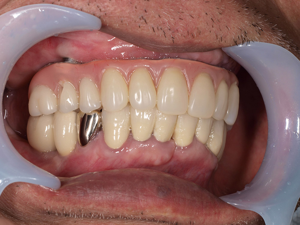 上顎4本で12歯（オールオン４）、下顎4本5歯