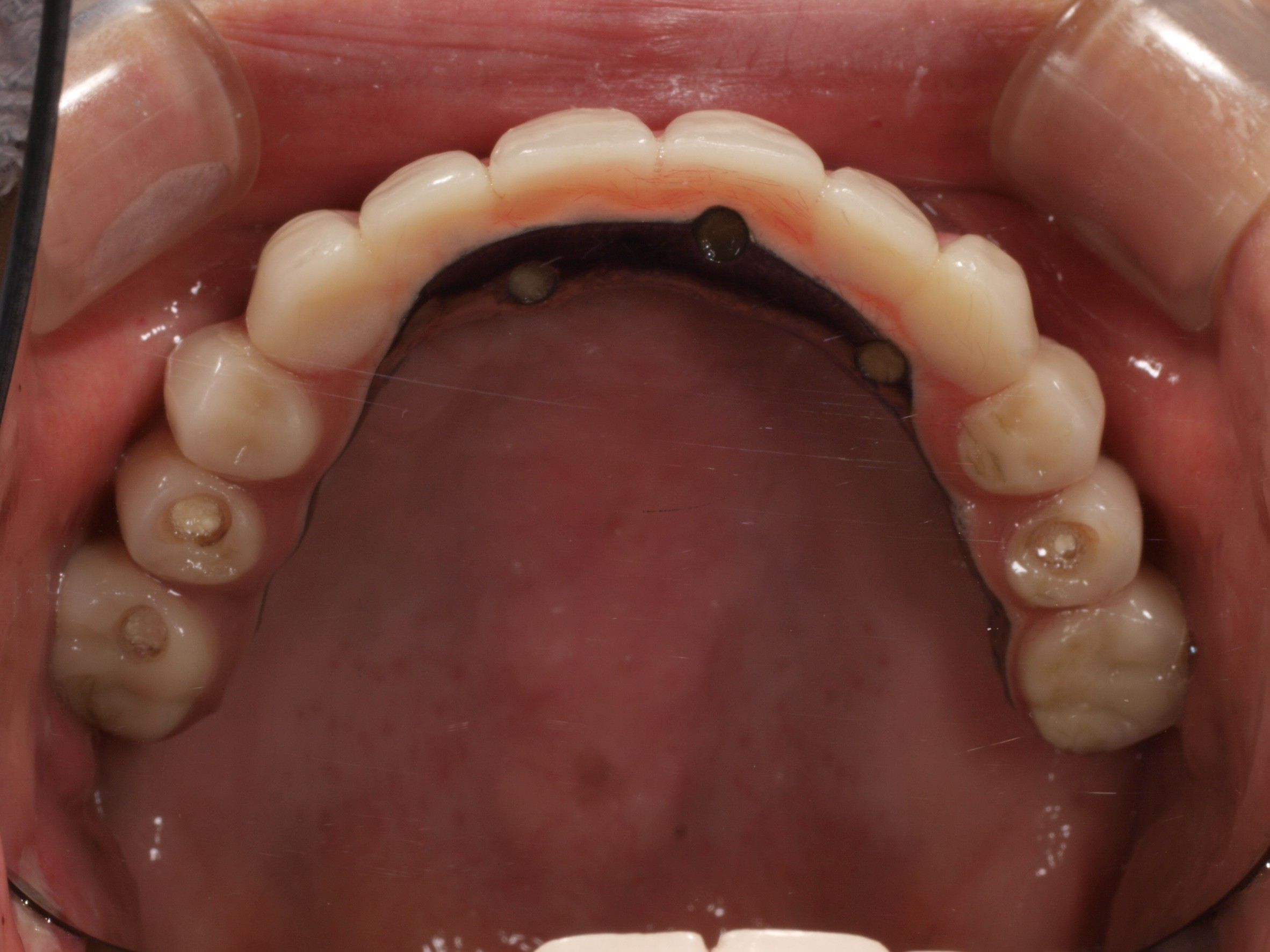 上顎4本で12歯（オールオン４）、下顎4本5歯