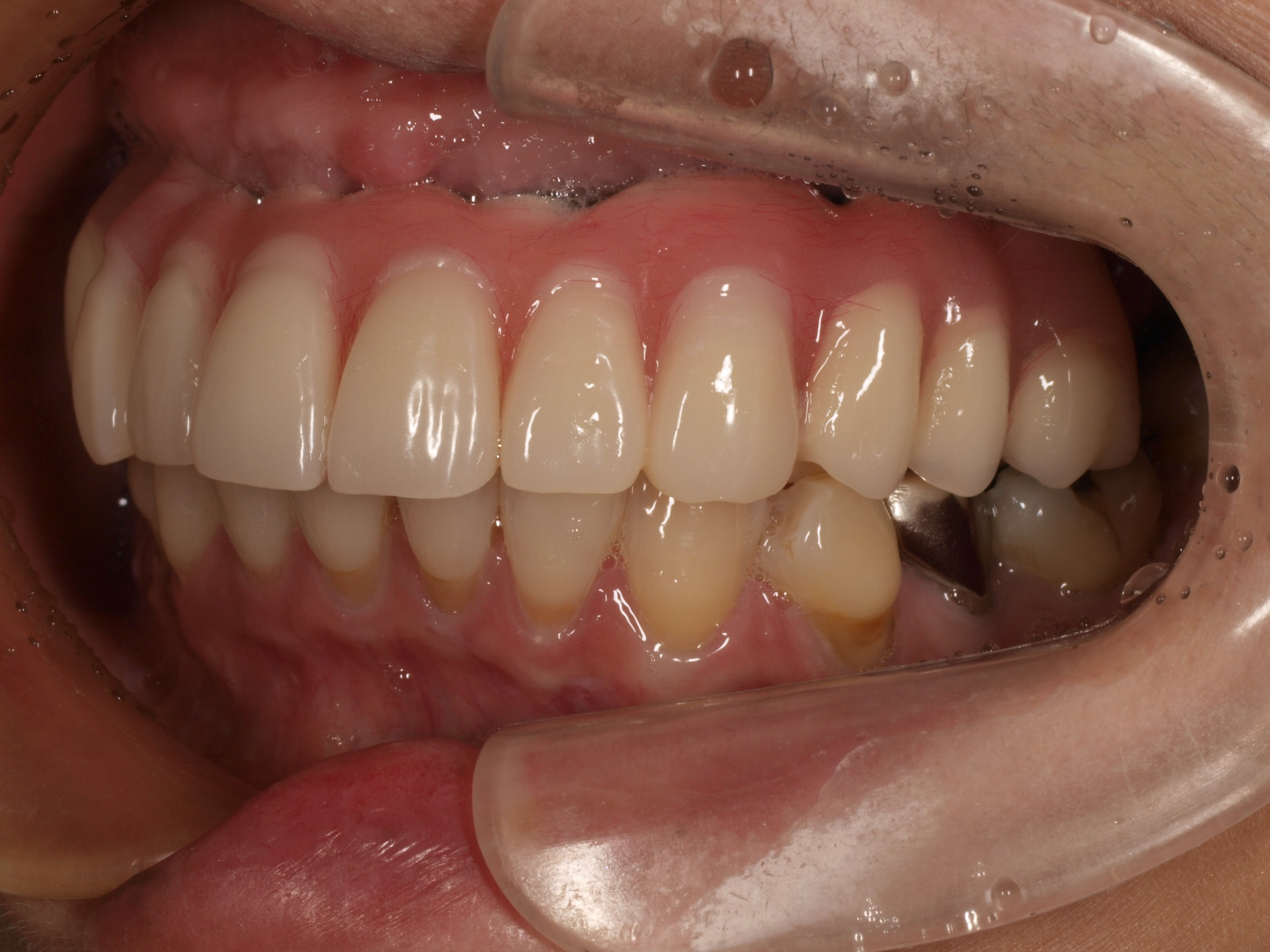 上顎4本で12歯（オールオン４）、下顎4本5歯