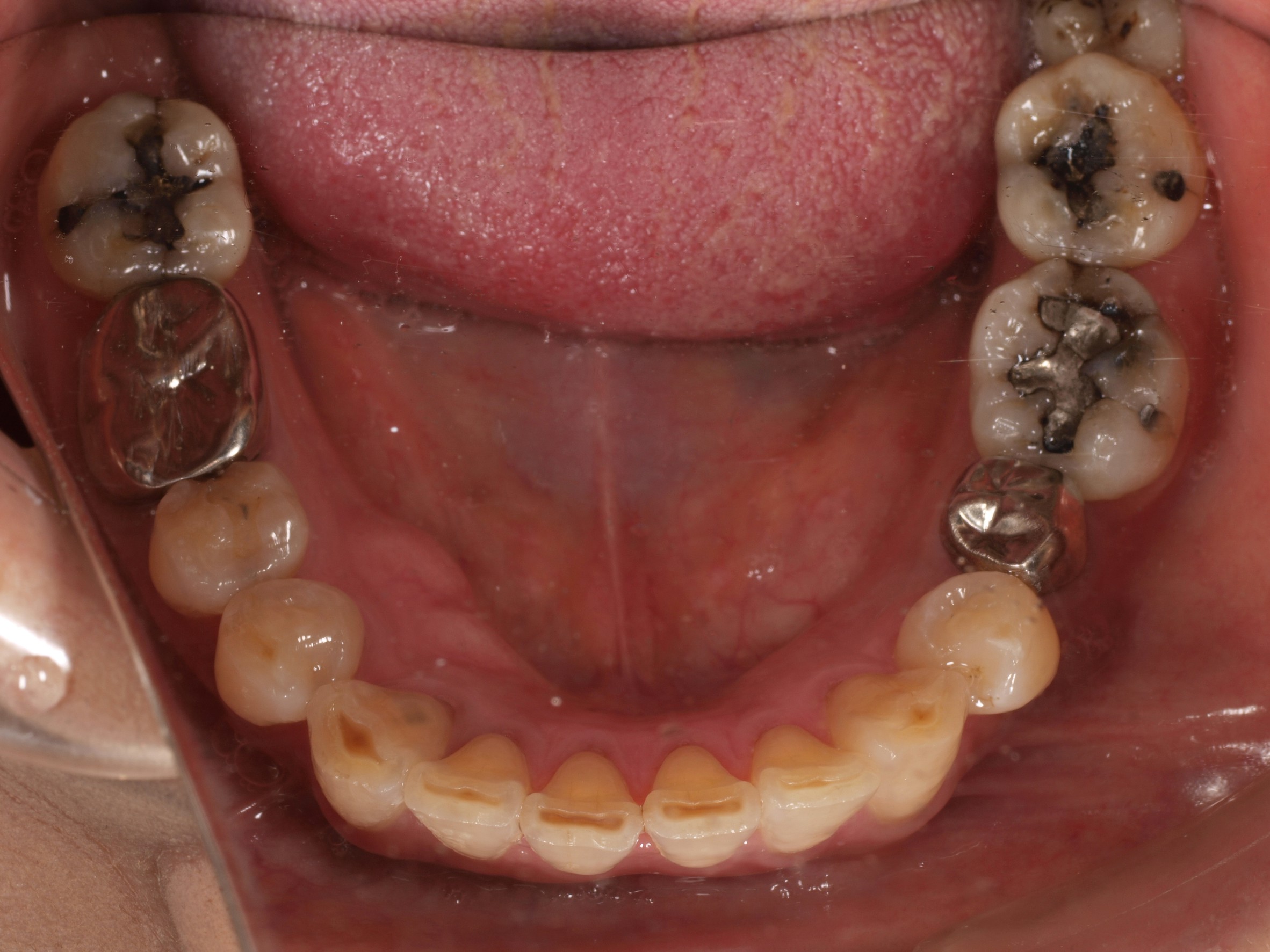 上顎4本で12歯（オールオン４）、下顎4本5歯