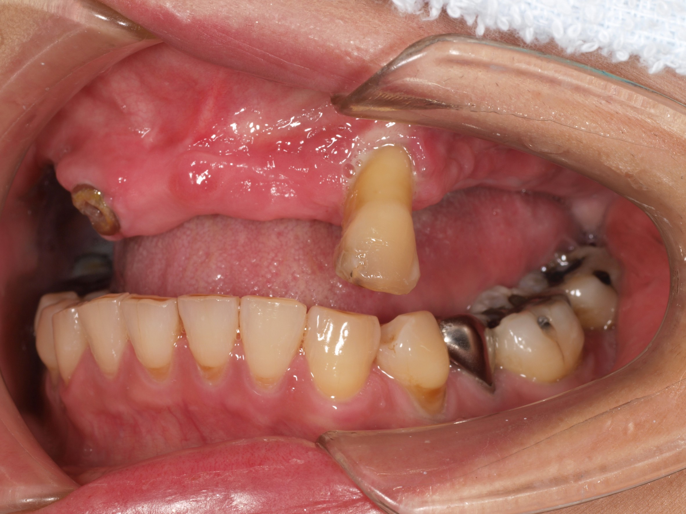 上顎4本で12歯（オールオン４）、下顎4本5歯