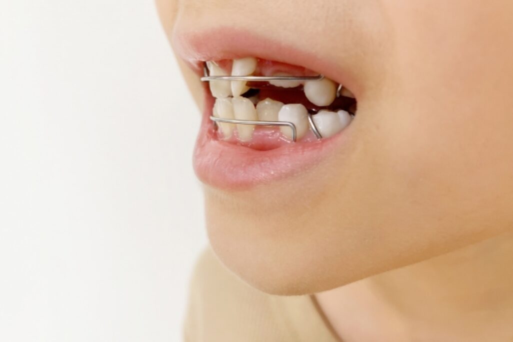 2期矯正（永久歯が生え揃った後）