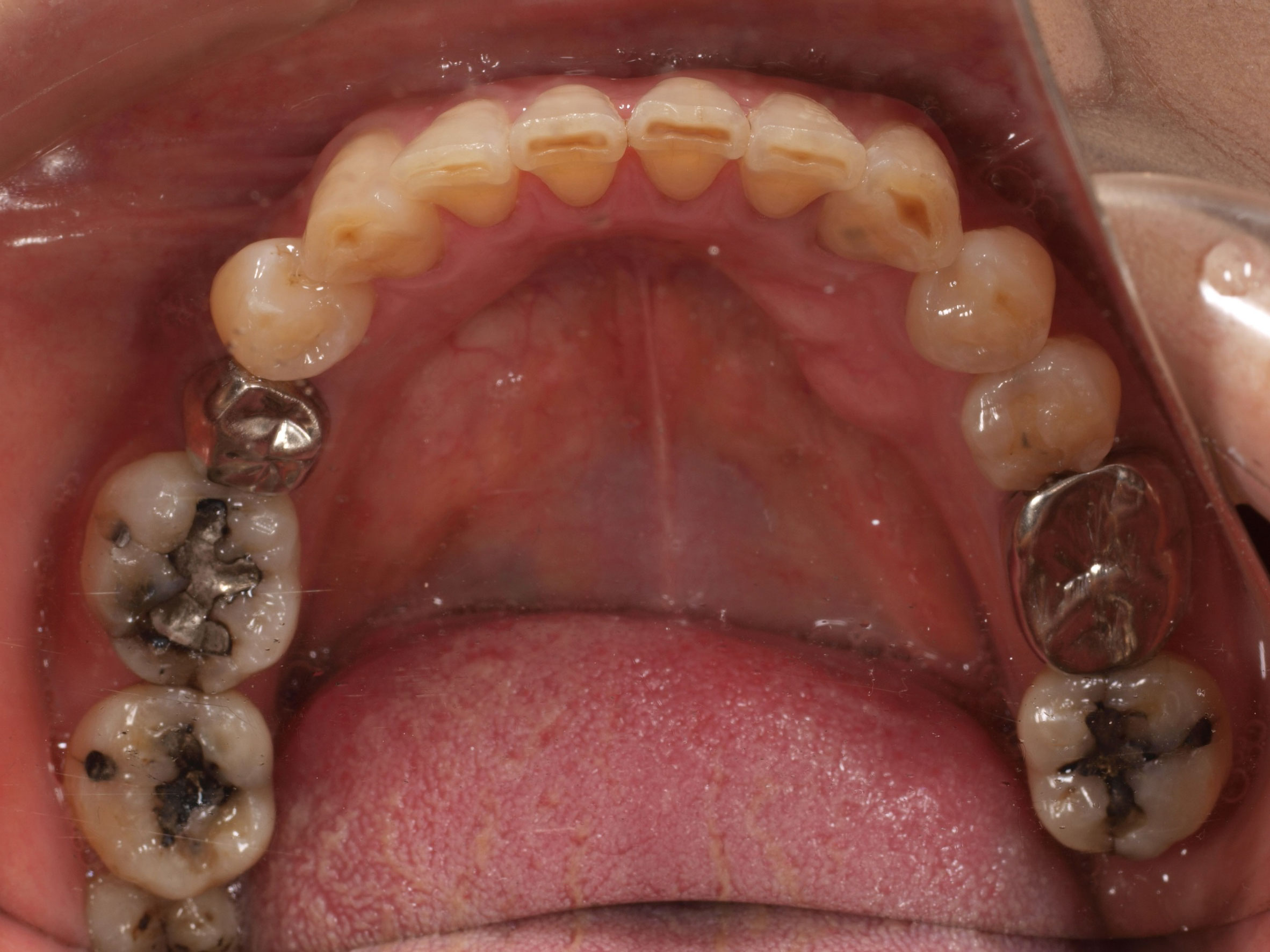 上顎4本で12歯（オールオン４）、下顎4本5歯