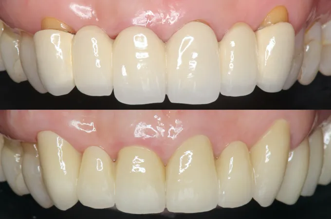 歯のセラミック治療とは?