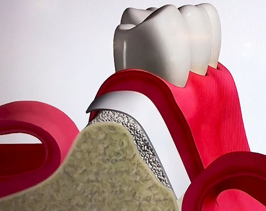 GBR（骨誘導再生法）