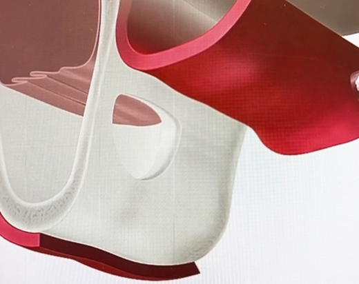 サイナスリフト法とは