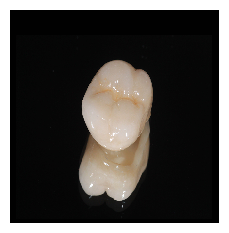 ジルコニア クラウン