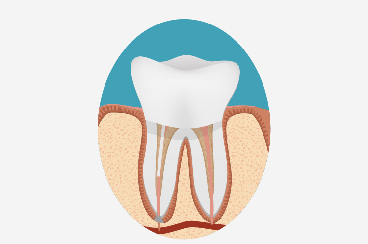 蓋をして治療終了(1回目)