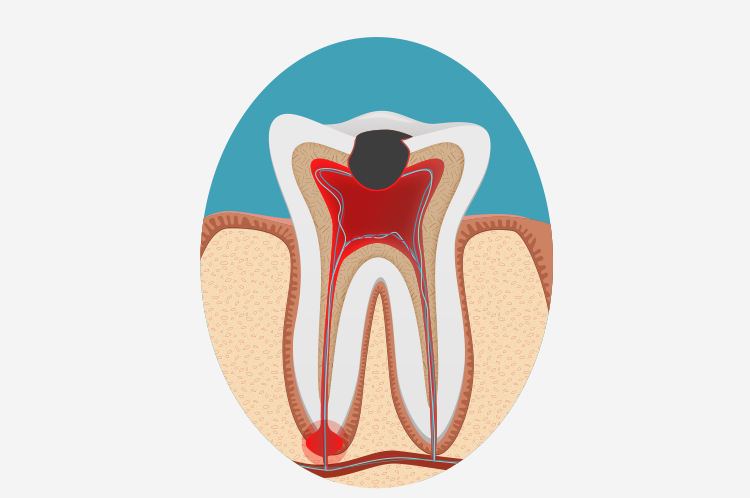 治療再開(蓋を外す)